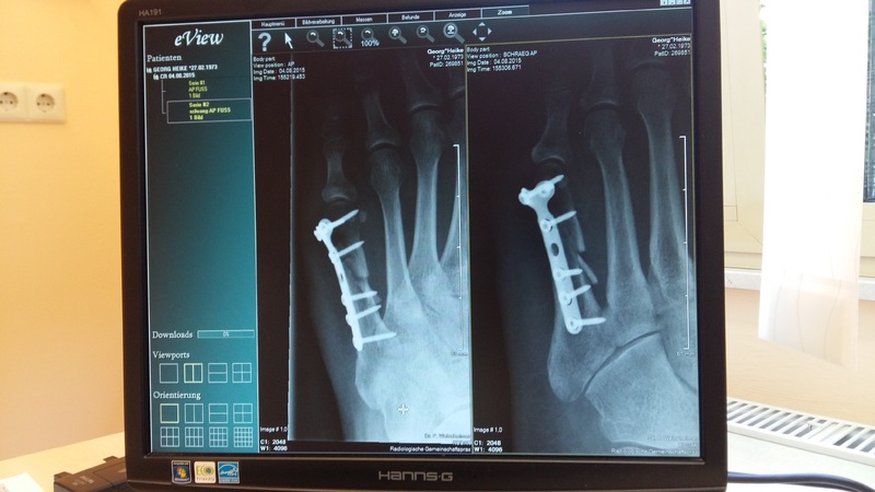 Врачи рассказали о сложностях, связанных с реабилитацией пациентов с травмами и ампутациями Врачи рассказали о сложностях, связанных с реабилитацией пациентов с травмами и ампутациями