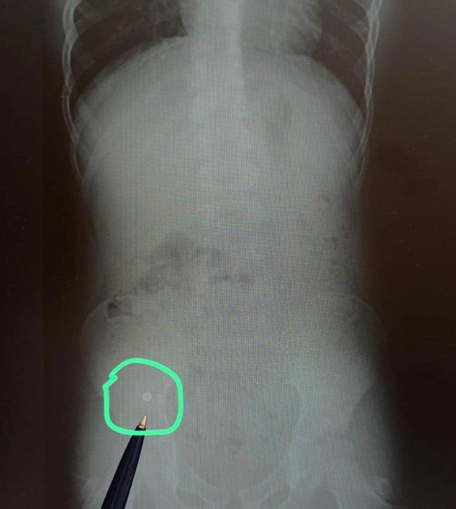 7-летний мальчик из Уфы проглотил шарики от магнитного конструктора: проведена экстренная операция