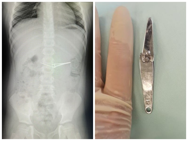 Съел щипцы: в Уфе врачи вытащили острый предмет из желудка шестилетнего мальчика | Шестилетний мальчик в Уфе проглотил щипцы, но выжил Съел щипцы: в Уфе врачи вытащили острый предмет из желудка шестилетнего мальчика | Шестилетний мальчик в Уфе проглотил щипцы, но выжил