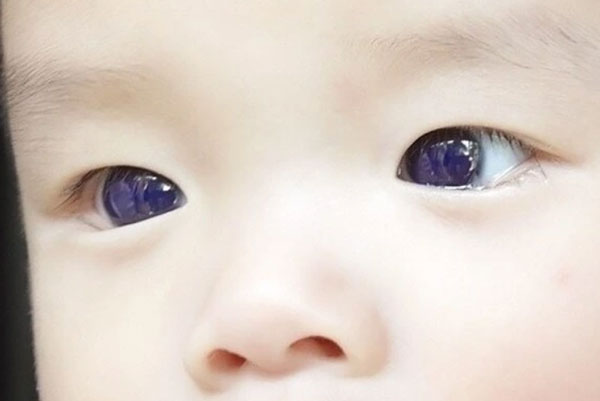 В Таиланде глаза шестимесячного малыша стали фиолетовыми, отреагировав на лекарство от ковида В Таиланде глаза шестимесячного малыша стали фиолетовыми, отреагировав на лекарство от ковида