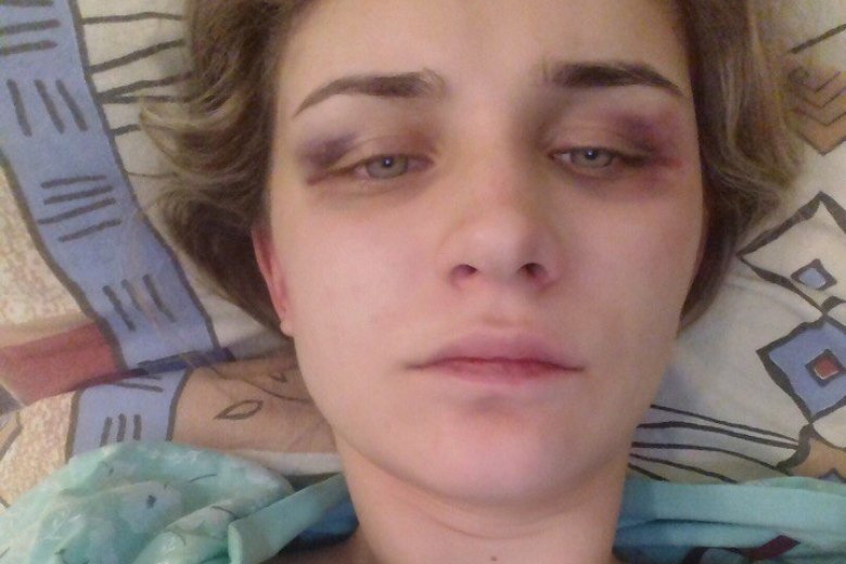 В Липецкой области мужчина жестоко избил экс-супругу и снял у нее часть скальпа