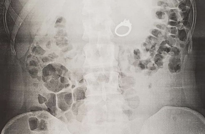 Американка проглотила во сне обручальное кольцо Американка проглотила во сне обручальное кольцо