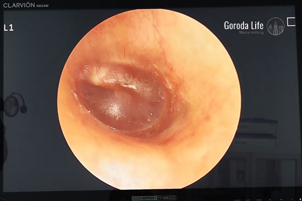 Врач рассказал, почему возникает отит и как вовремя его распознать
