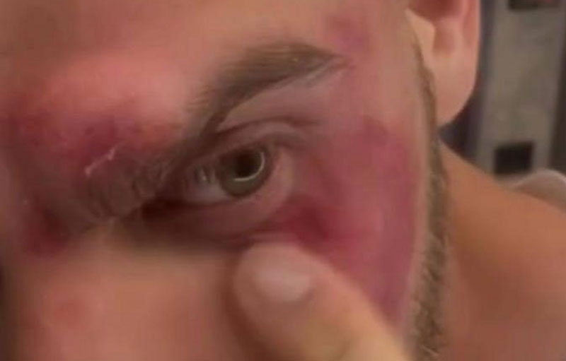 Фитнес-тренер в Мытищах получил травму лица от штанги весом 100 кг | В Мытищах тренер уронил штангу себе на лицо во время жима Фитнес-тренер в Мытищах получил травму лица от штанги весом 100 кг | В Мытищах тренер уронил штангу себе на лицо во время жима