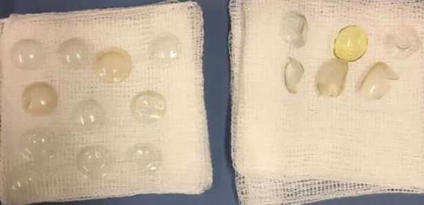 В глазу у британки обнаружили 27 потерявшихся линз В глазу у британки обнаружили 27 потерявшихся линз