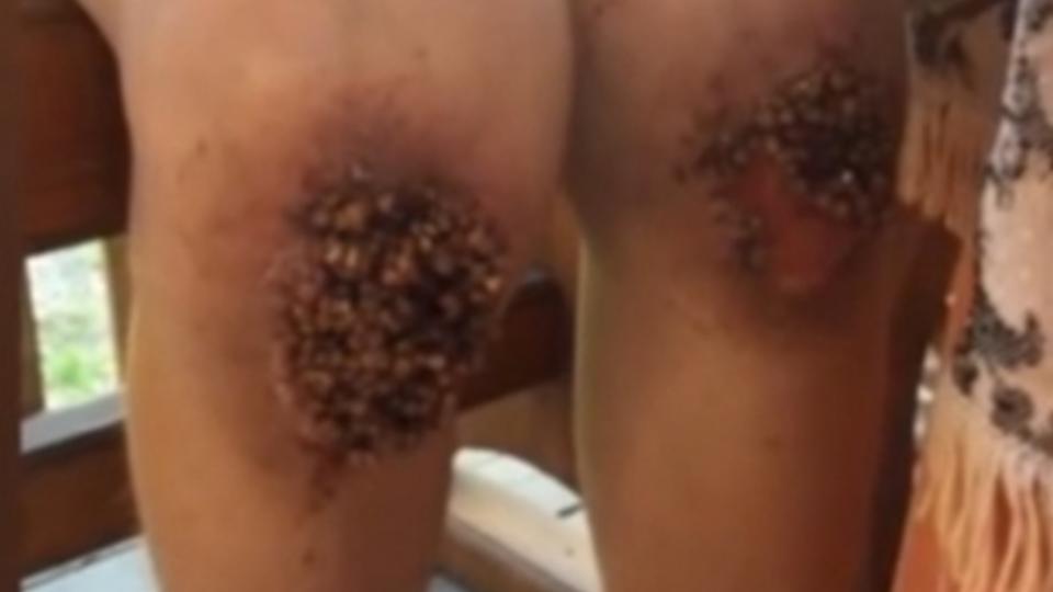 В Омске мальчику в колени вросла гречка из-за частых наказаний отчима В Омске мальчику в колени вросла гречка из-за частых наказаний отчима