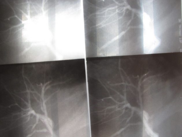 Онкологи нашли способ лечить рак нервной системы