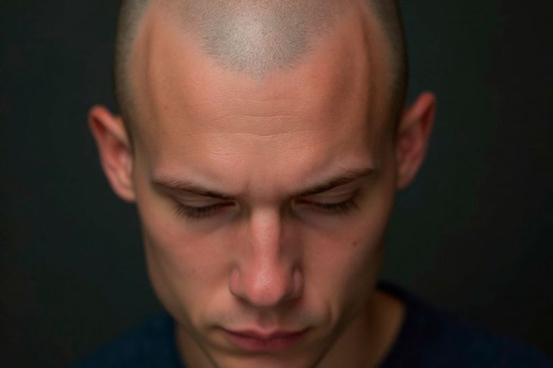 Названы пять главных причин облысения у мужчин и у женщин | Эксперт Гассеев назвал ключевые причины раннего облысения у мужчин и женщин Названы пять главных причин облысения у мужчин и у женщин | Эксперт Гассеев назвал ключевые причины раннего облысения у мужчин и женщин