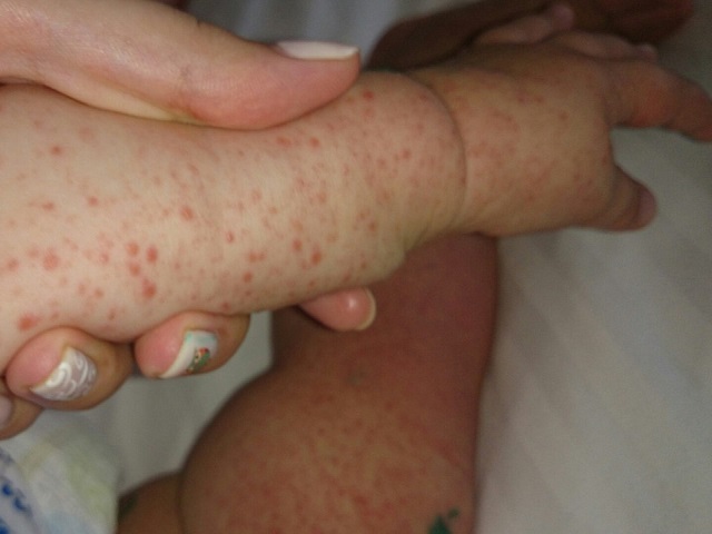 Годовалый челябинец подхватил в Турции вирус коксаки Годовалый челябинец подхватил в Турции вирус коксаки